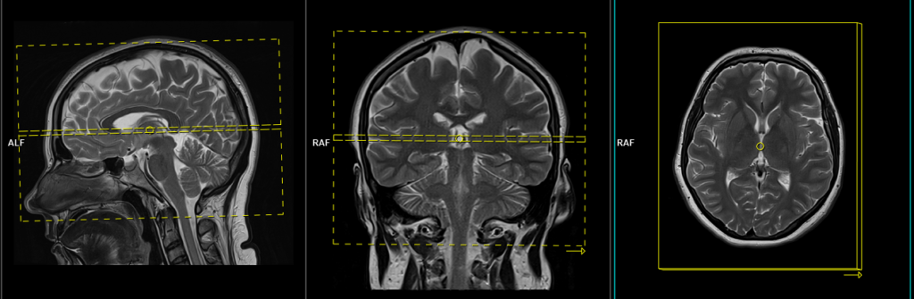 Planificación geométrica: T2 TSE Axial 3mm (Encéfalo - Eje Subcalloso)