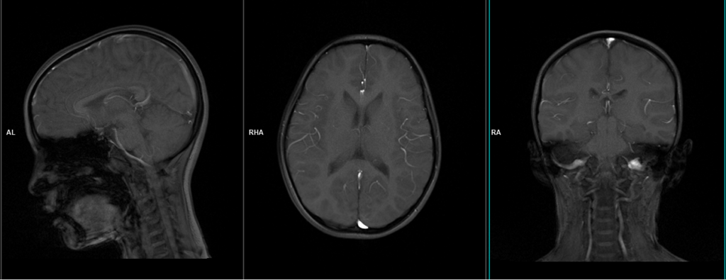 RM Cerebral Pediátrica y Neonatal